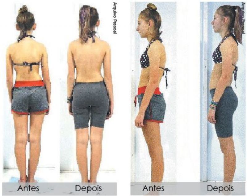 Melhora Postural em Paciente após Tratamento de Reposicionamento